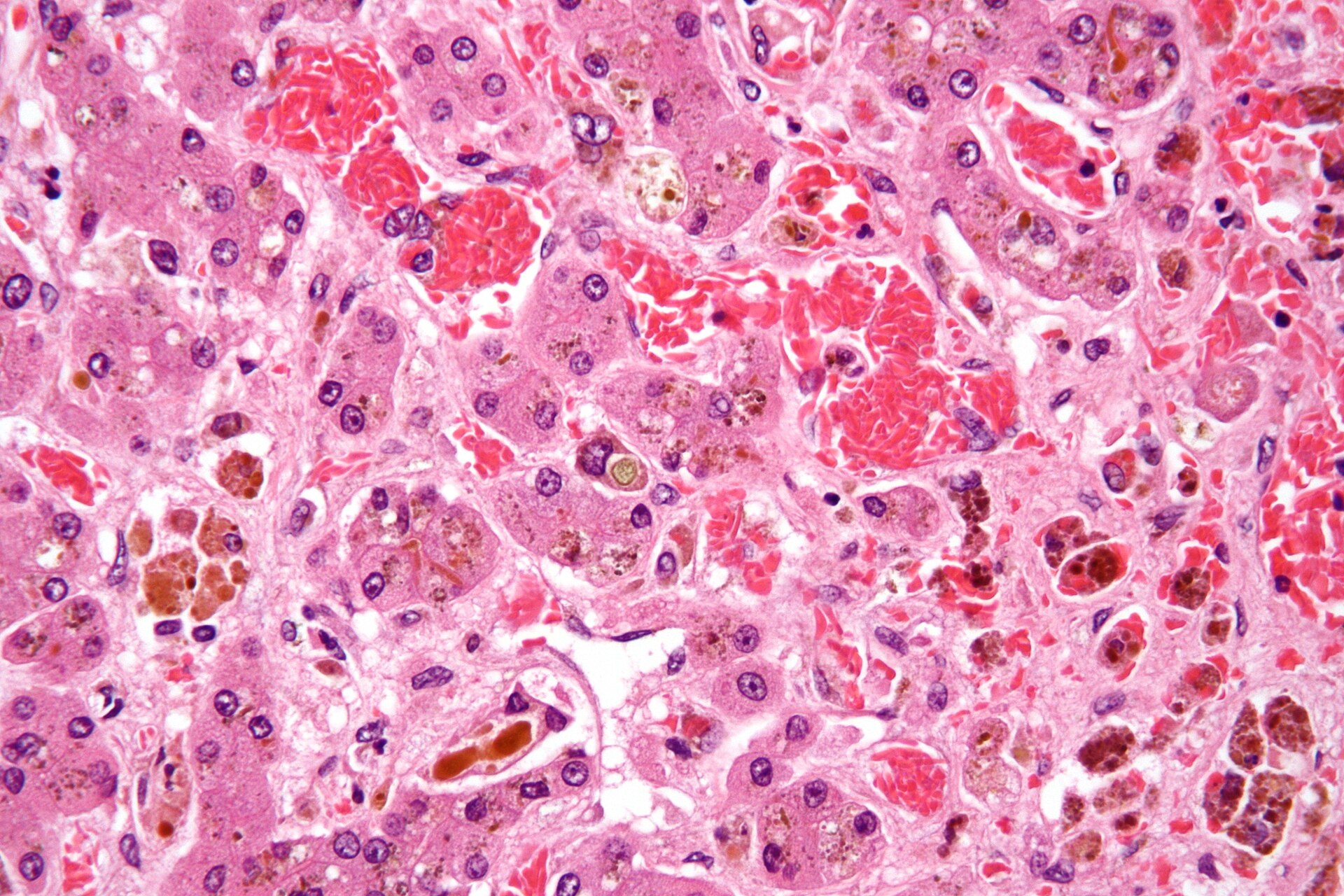 Imagem de referência de anemia falciforme, descrito nos dados abertos como doença Sanguínea onde algumas Hemácias Anormais Apresentam Forma de foice