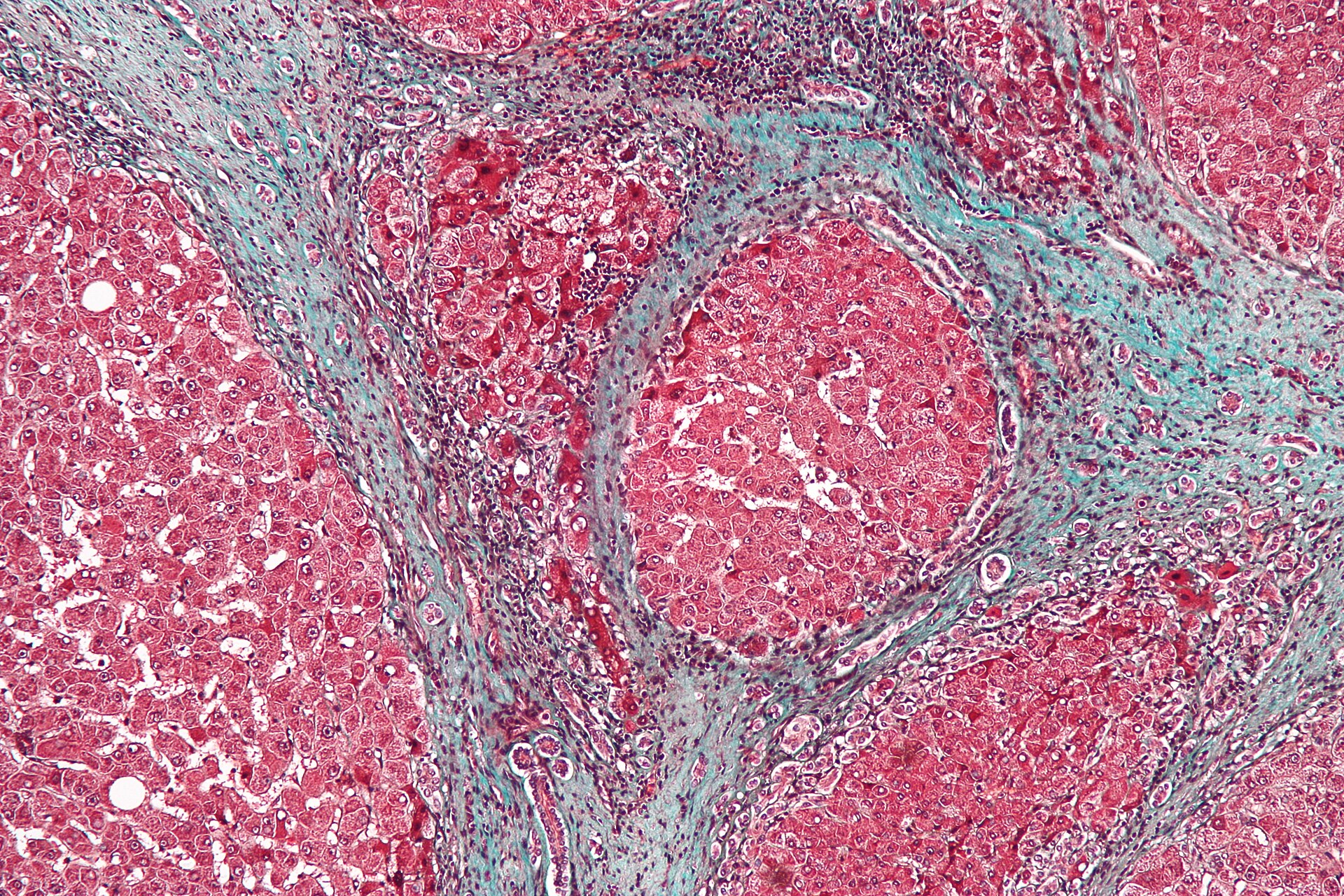 Imagem de referência de síndrome hepatorrenal, descrito nos dados abertos como deterioração da função renal em pessoas com cirrose ou insuficiência hepática fulminante