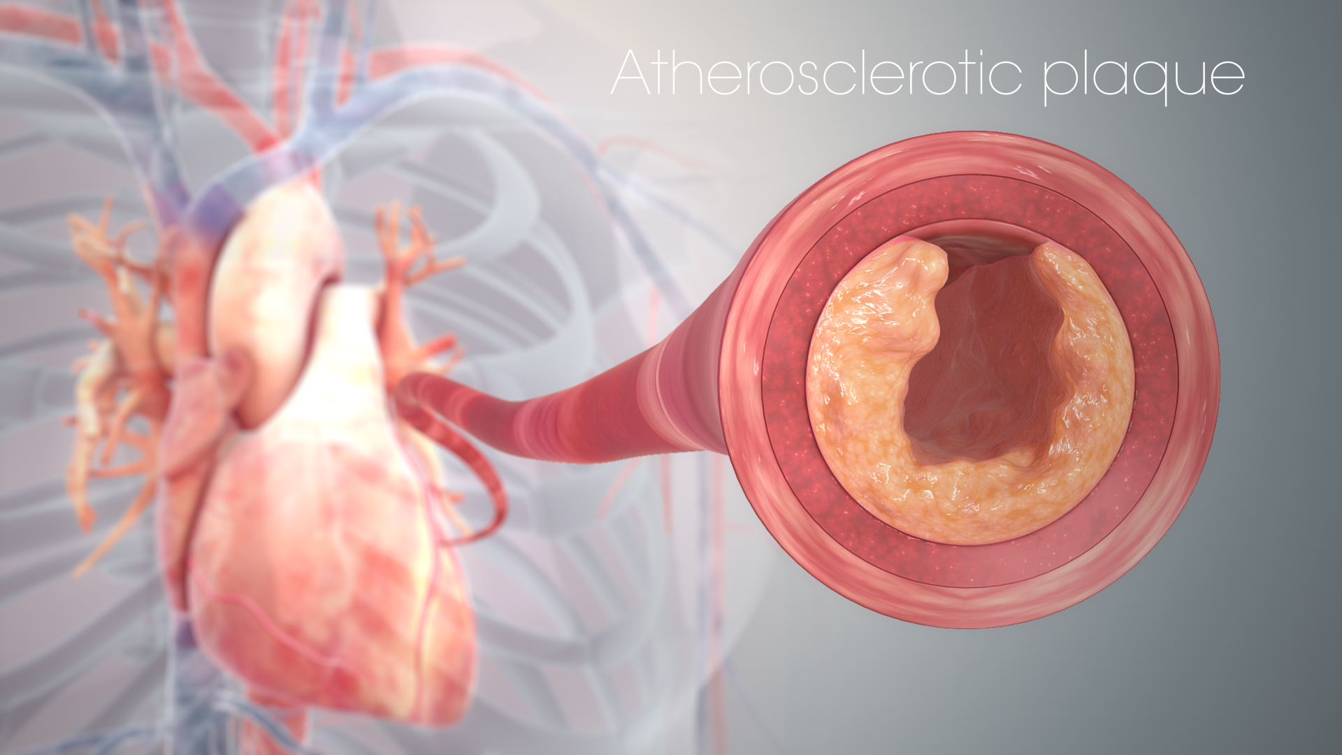 Imagem de referência de cardiopatia isquémica, descrito nos dados abertos como doença arterial coronariana obstrutiva