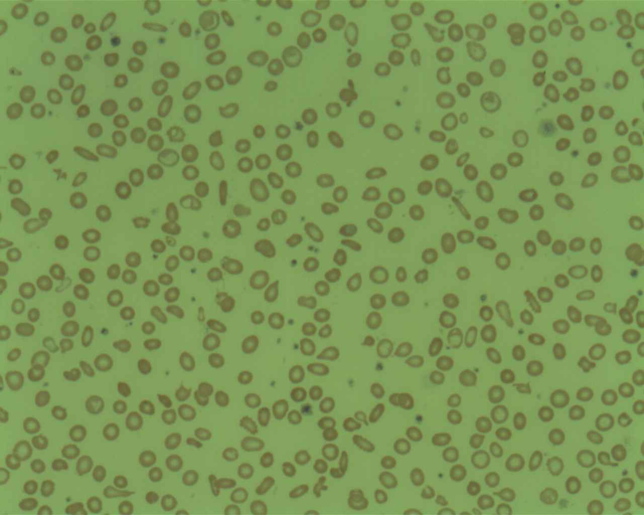 Imagem de referência de anemia microcítica, descrito nos dados abertos como doença humana