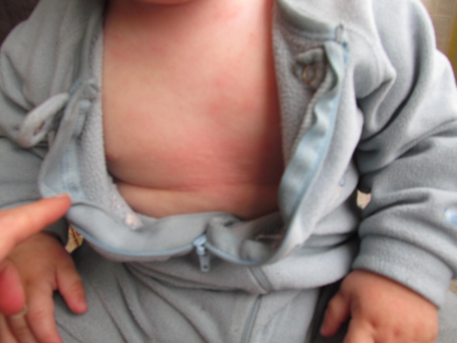 Imagem de referência de alergia ao leite, descrito nos dados abertos como reação exagerada do sistema imune à proteína do leite da vaca