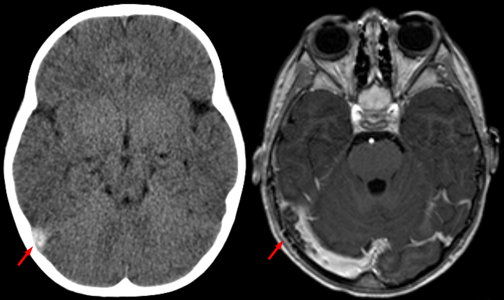 Imagem de referência de Trombose venosa cerebral, descrito nos dados abertos como presença de um trombo nos seios venosos durais (que drenam o sangue do cérebro) ou nas veias cerebrais ou em ambos