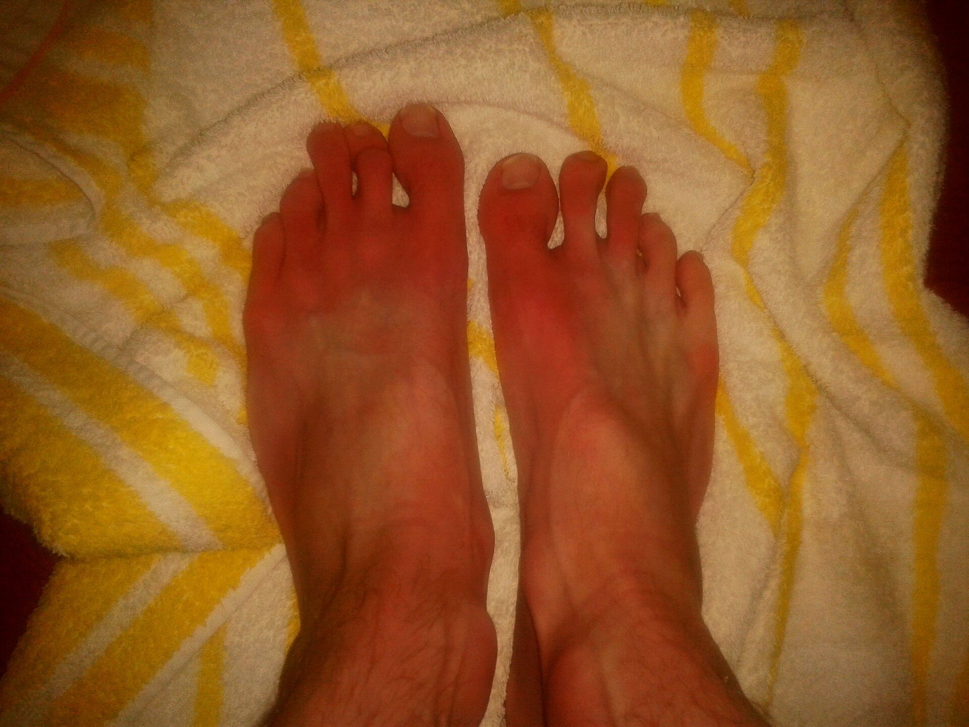 Imagem de referência de eritromelalgia, descrito nos dados abertos como doença vascular rara