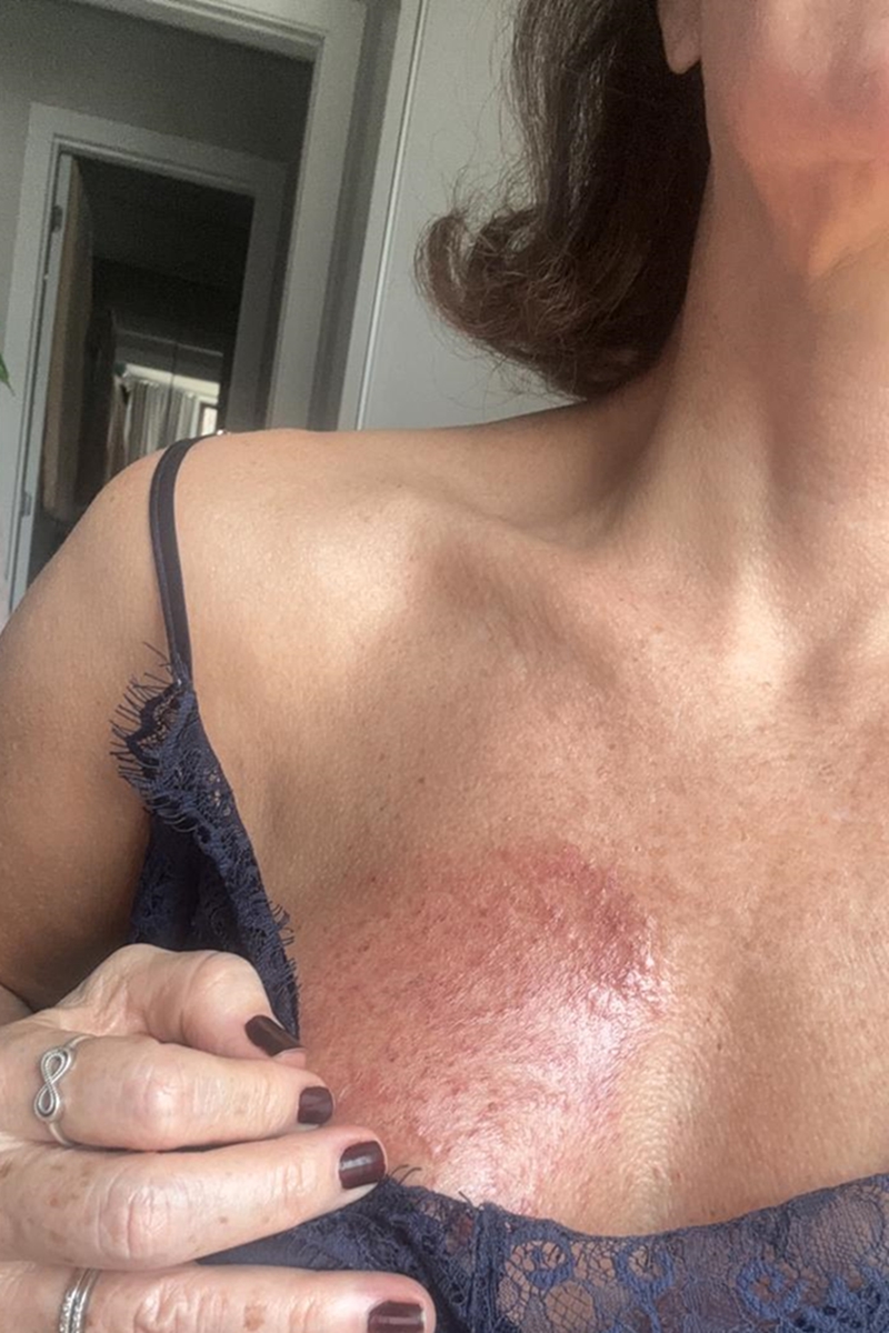 Mulher descobre câncer na cirurgia para trocar silicone: “Foi um choque”